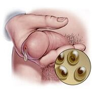 Chlamydia-afscheiding